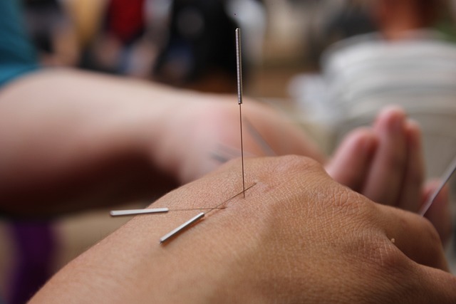 Akupunktura – takto funguje léčitelské umění z Číny